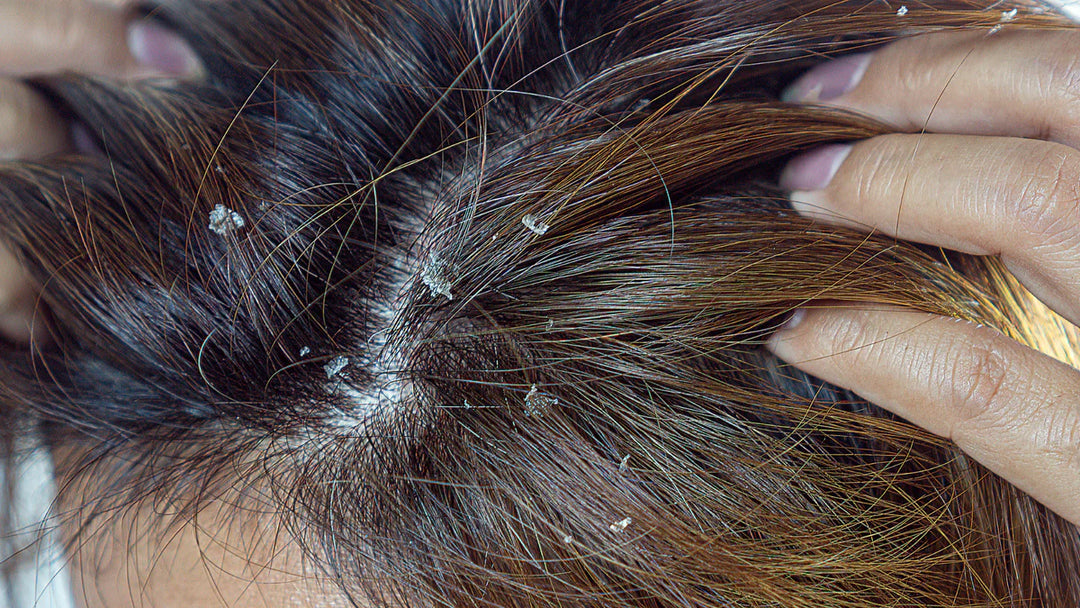 Dandruff Treatment Category Header and Product Banner