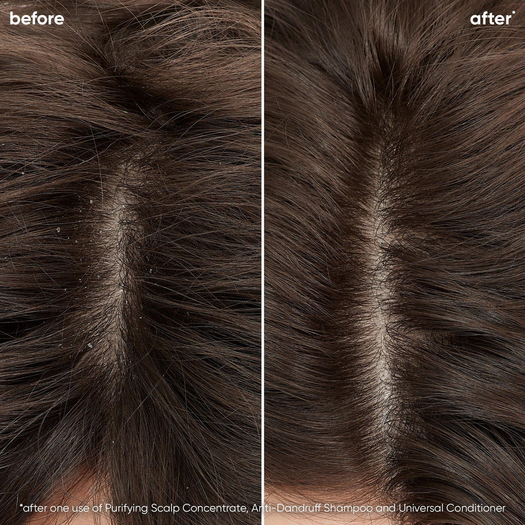 Biolage Scalp Sync Anti-Dandruff Shampoo model before and after